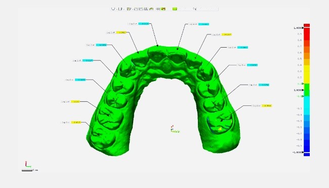 Точность интерорального 3D сканера Aoralscan 3